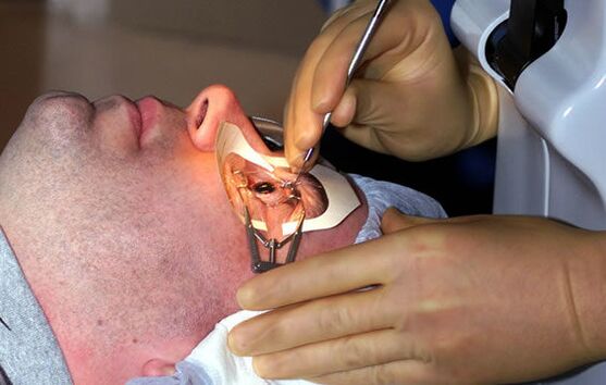 Skleroplastika za kratkovidnost za stabilizacijo vida