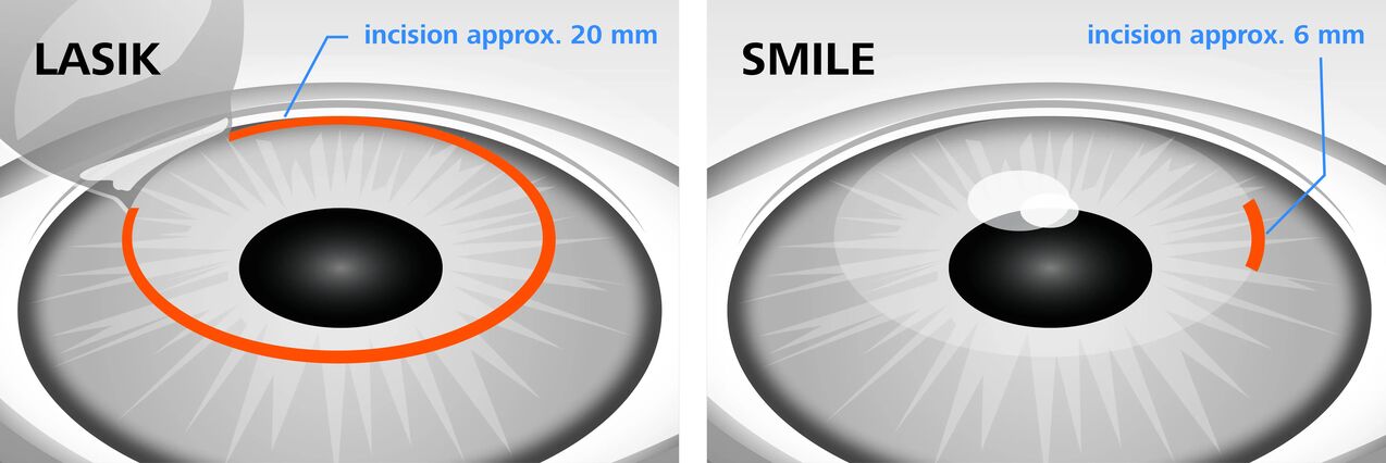 Primerjava metod laserske korekcije vida LASIK in SMILE